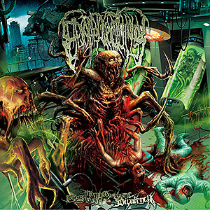 EPICARDIECTOMY - Putreseminal Morphodysplastic...